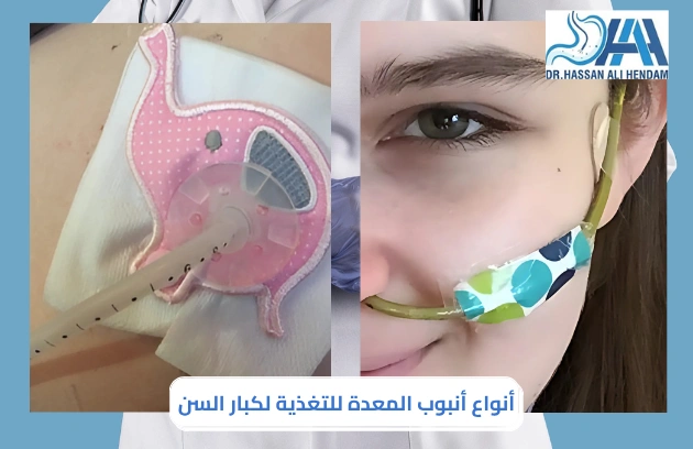 أنبوب تغذية في البطن 