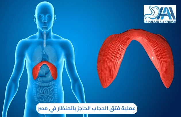 سعر عملية فتق الحجاب الحاجز بالمنظار