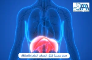 سعر عملية فتق الحجاب الحاجز بالمنظار