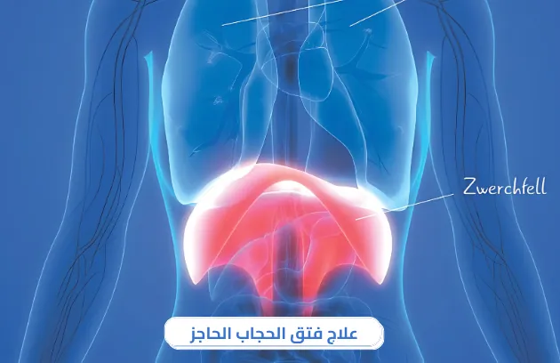 ماهي اعراض فتق الحجاب الحاجز