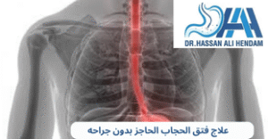 علاج فتق الحجاب الحاجز بدون جراحه