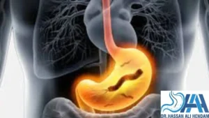 علاج جرثومة المعدة نهائيا