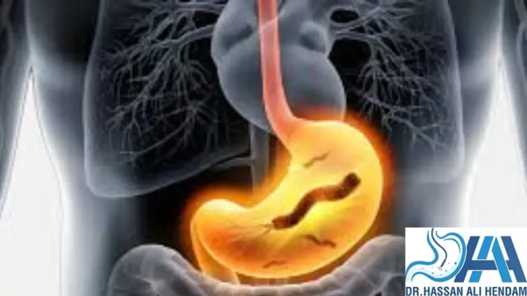 علاج جرثومة المعدة نهائيا