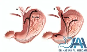 علاج ارتجاع المرئ أثناء النوم