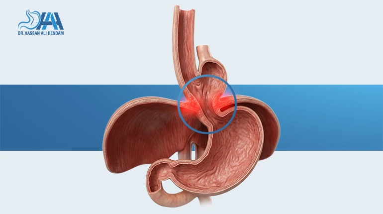 علاج فتق الحجاب الحاجز
