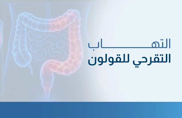 التهاب التقرحي للقولون