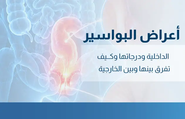 أعراض البواسير الداخلية